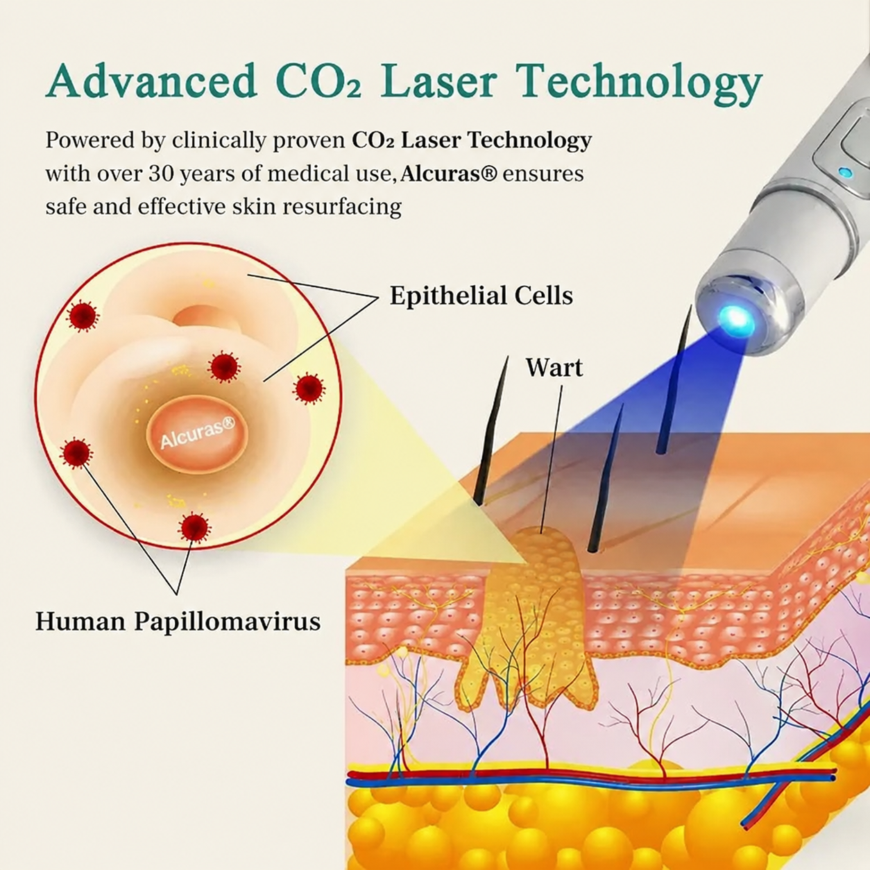 Mresio® HPV Genital Warts Removal Laser Pen