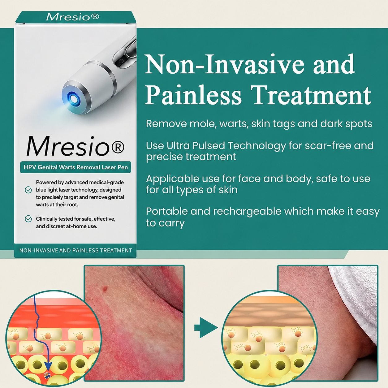 Mresio® HPV Genital Warts Removal Laser Pen