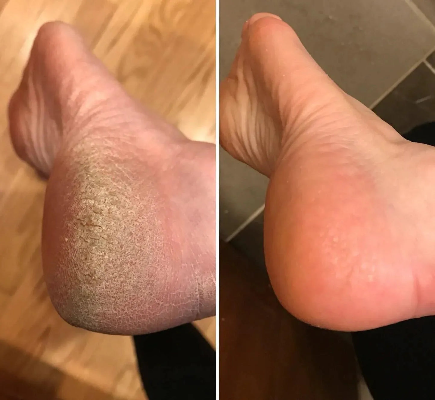 Alcuras®️ The Promise: Sandal Confidence Again—Without Shame, Without Pain, Without Recurrence