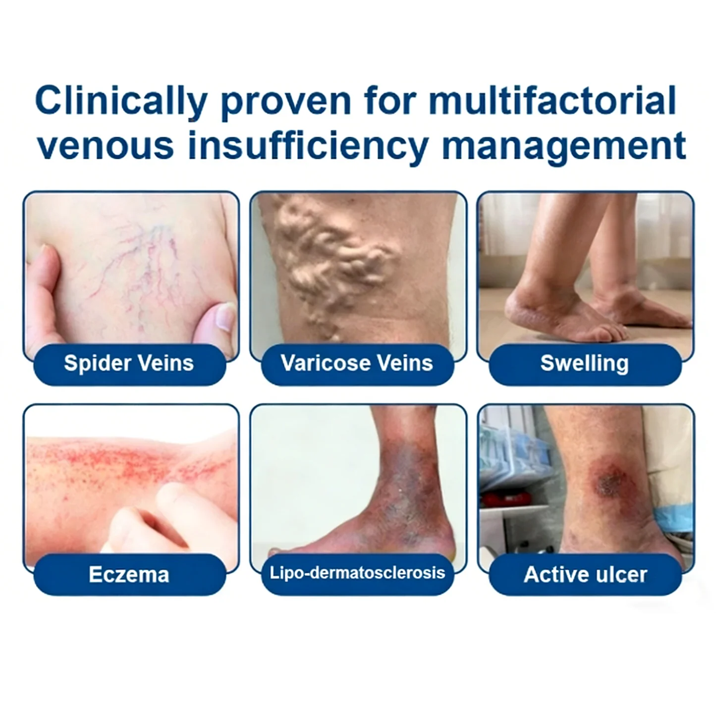 Alcuras® Vein Contour Microneedle Patch – 7-Day Visible Results for Varicose Veins