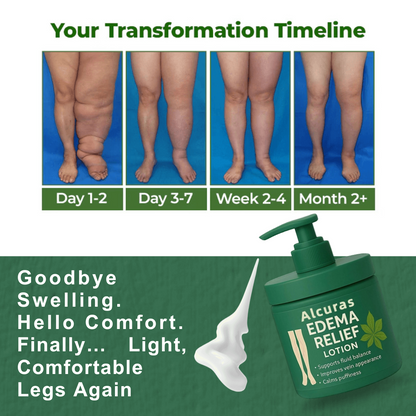 Alcuras™ Edema Relief Lotion