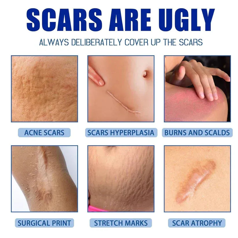 Alcuras Medical Grade Silicone Scar Cream – Smooth Scars Fast!