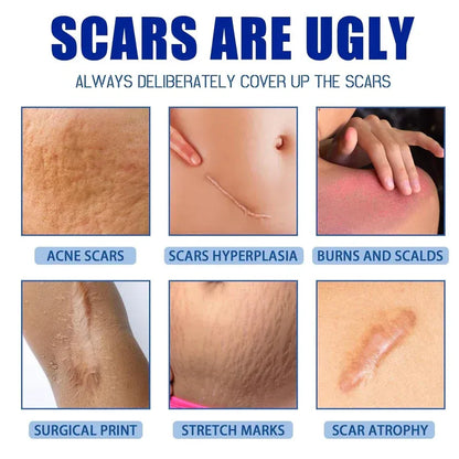 Alcuras Medical Grade Silicone Scar Cream – Smooth Scars Fast!